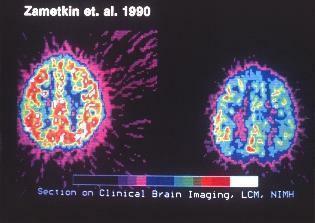 kliinisen aivojen kuvantamiskannaus adhd: n suhteen