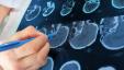 3D-aivoskannaukset voivat parantaa ADHD-diagnoosin tarkkuutta