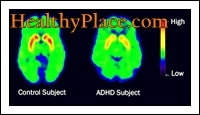 Termejä ADD ja ADHD on käytetty keskenään. Päivitetty termi DSM IV: n mukaan on kuitenkin ADHD (Attention Deficit Hyperactivity Disorder).